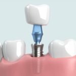 Dental Crowns: Restoring Strength and Beauty to Damaged Teeth