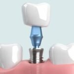 5 Reasons Why Dental Implants Are the Gold Standard for Tooth Replacement