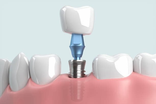 Dental Crowns: Restoring Strength and Beauty to Damaged Teeth