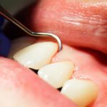 Bleeding Gums: Causes, Treatment, and Prevention