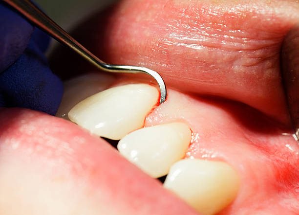 Bleeding Gums: Causes, Treatment, and Prevention