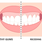 Do Receding Gums Grow Back? The Truth About Gum Recession