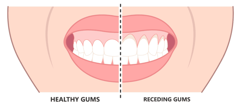 Do Receding Gums Grow Back? The Truth About Gum Recession