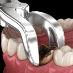 Wisdom Teeth Removal: Understanding the Procedure and Its Benefits