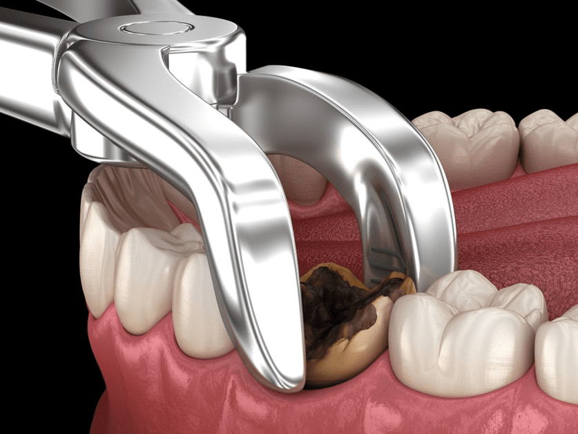 Wisdom Teeth Removal: Understanding the Procedure and Its Benefits