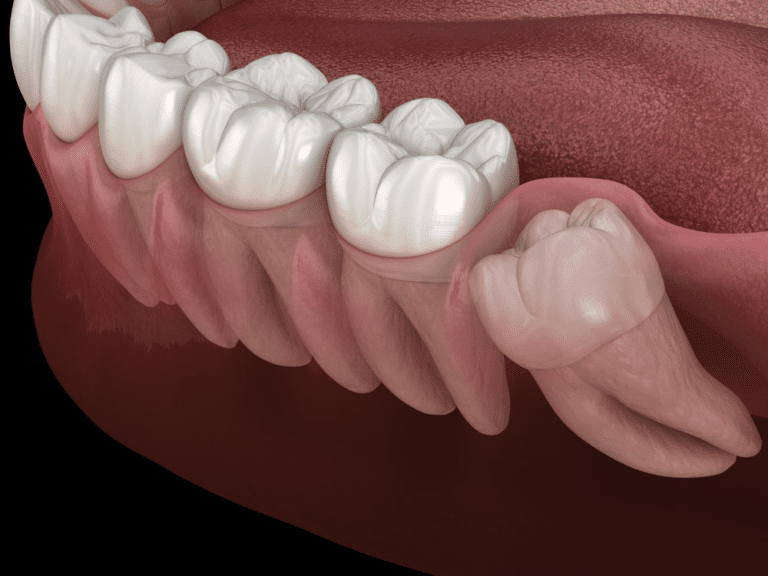 Wisdom Teeth: Myths Revealed