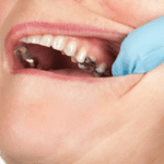 What Causes Tooth Decay? Understanding and Preventing Cavities