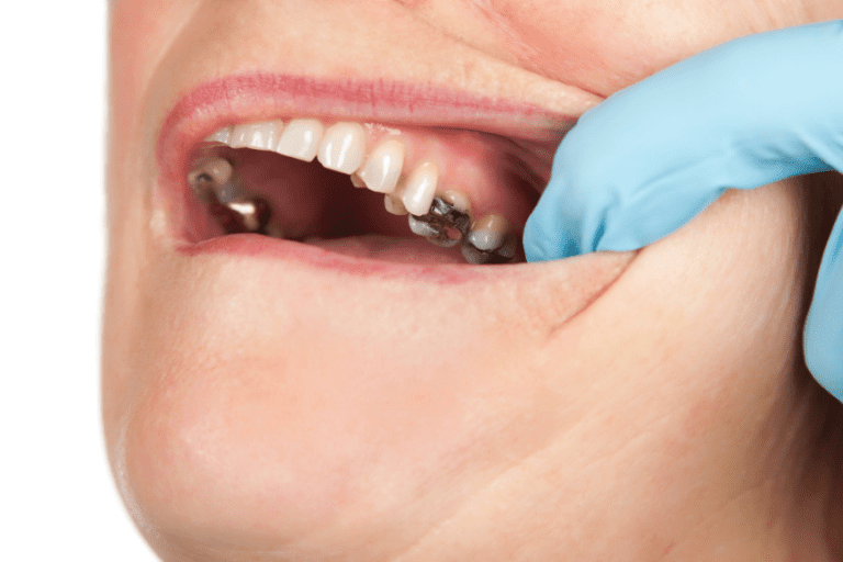 What Causes Tooth Decay? Understanding and Preventing Cavities