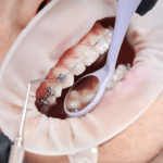 5 Things to Consider Before Getting Adult Braces