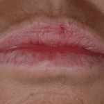 Everything You Need to Know About Lip Cancer: Symptoms, Causes, and Treatment