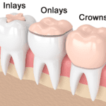 Inlays and Onlays: Restoring Teeth with Strength and Precision