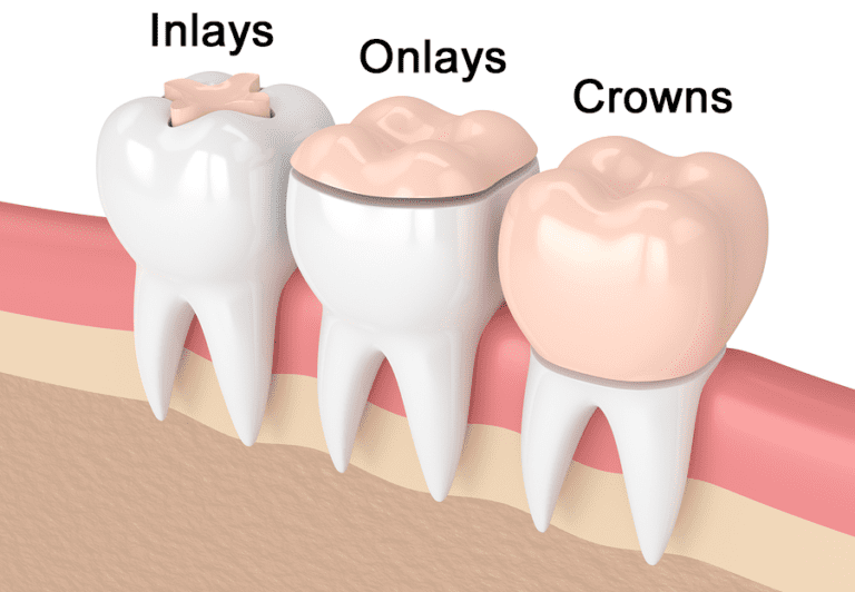 Inlays and Onlays: Restoring Teeth with Strength and Precision