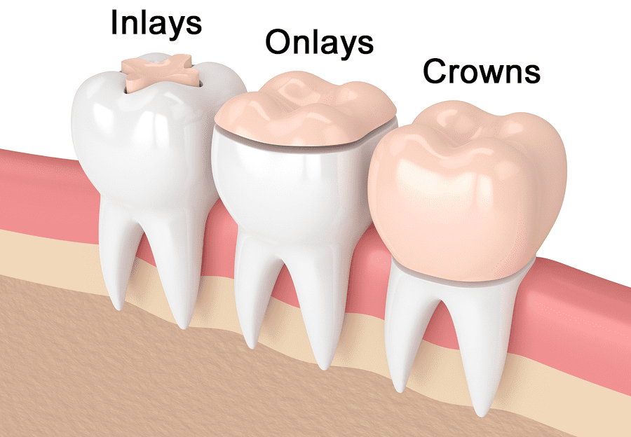 The Dental Inlay and Onlay Procedure