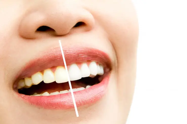 3. Removes Stains and Discoloration: Teeth whitening effectively removes stubborn stains and discoloration caused by factors such as aging, smoking, and consuming certain foods and beverages.