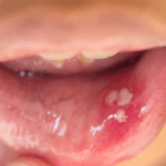 Mouth Sores