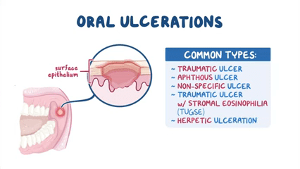 Types of Mouth Sores