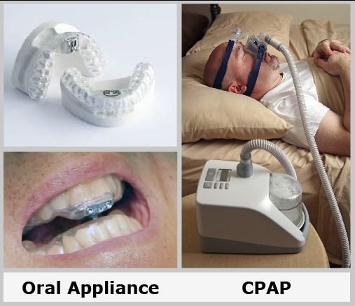 Types of oral sleep devices available on the market