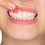 How to Stop Bleeding Gums: Causes, Treatment, and Prevention