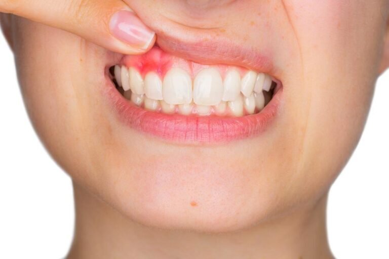 How to Stop Bleeding Gums: Causes, Treatment, and Prevention