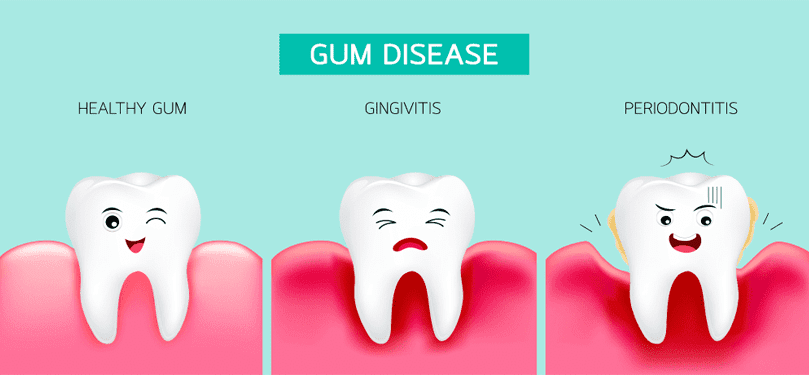 Common Gum Problems