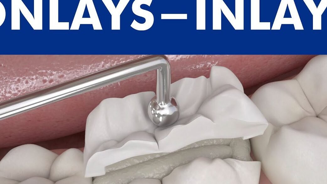 Difference between inlays, onlays, and traditional fillings