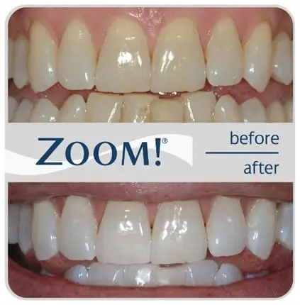 zoom teeth whitening cost