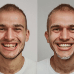 Teeth Whitening Before and After: Real Results That Will Shock You!