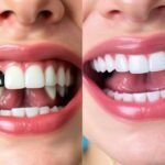 before and after dental implants