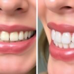 dental bonding before and after