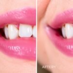 gum graft before and after