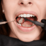 gum graft before and after