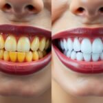 teeth whitening before and after results