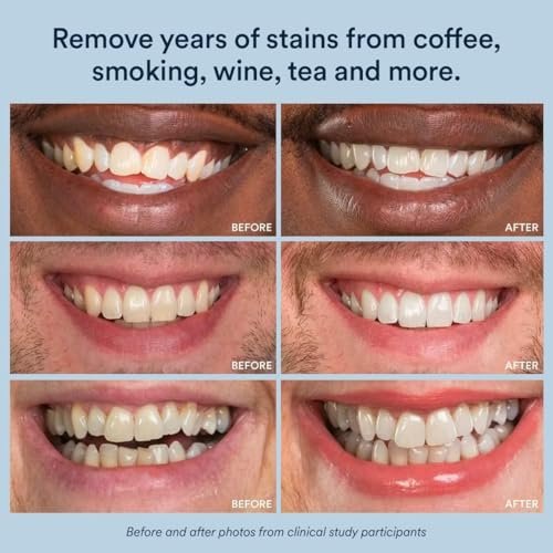 Auraglow Sensitive Teeth Whitening Strips, 14 Whitening Treatments, 4% Hydrogen Peroxide with Nano Hydroxyapatite (nHAp), 28 Strips, Mint