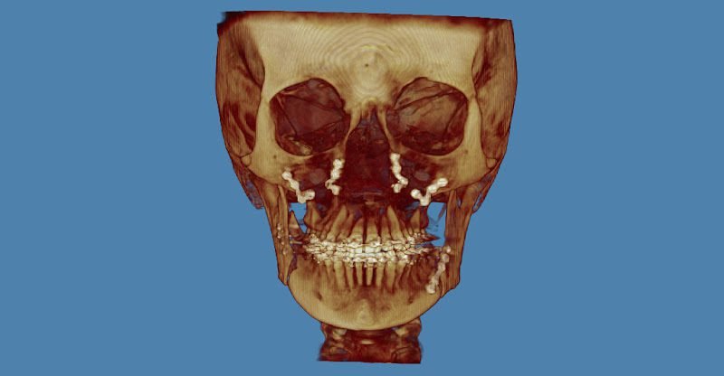 Arizona Jaw Surgery
