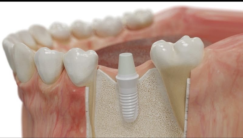 Ceramic Dental Implant Center