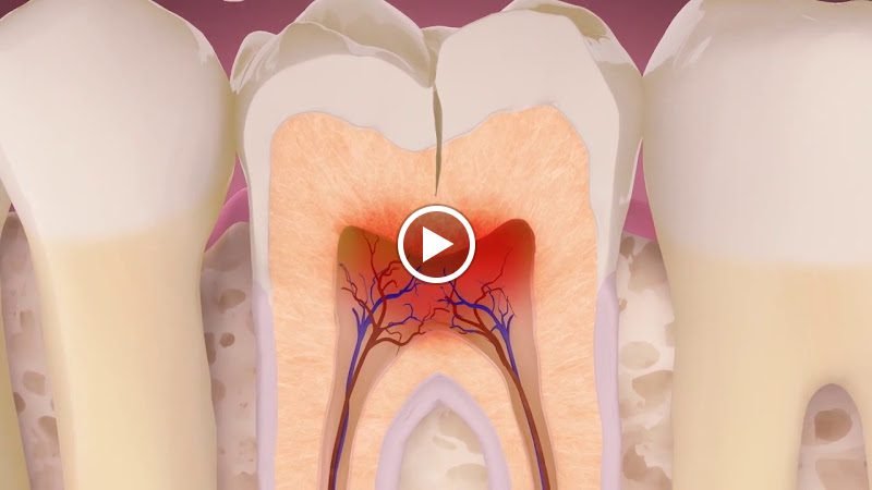 Compassionate Endodontics:Hossein S Moosavi DDS,MDS 3