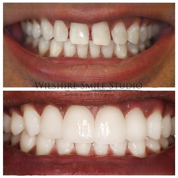 Dental Veneers Specialist On Wilshire - Los Angeles Cosmetic Dentist