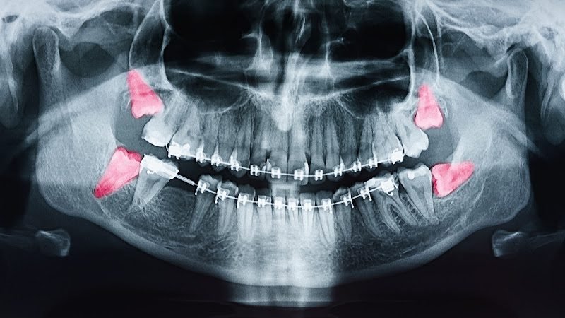 Purely Wisdom Teeth- Wisdom Teeth Removal Surgery Center
