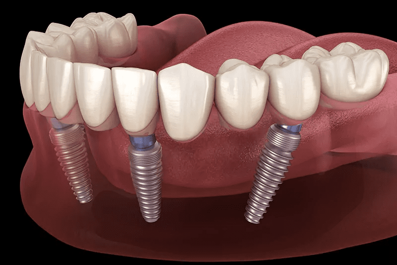 Renew Smiles Dental Implant Center – Phoenix 2