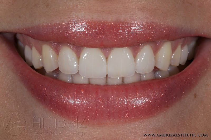 Smart Arches Dental Implants - New York 6