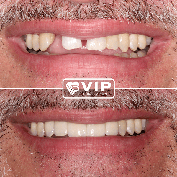 VIP Dental Implants Uptown