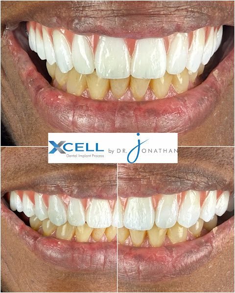 Xcell Dental Implants NYC