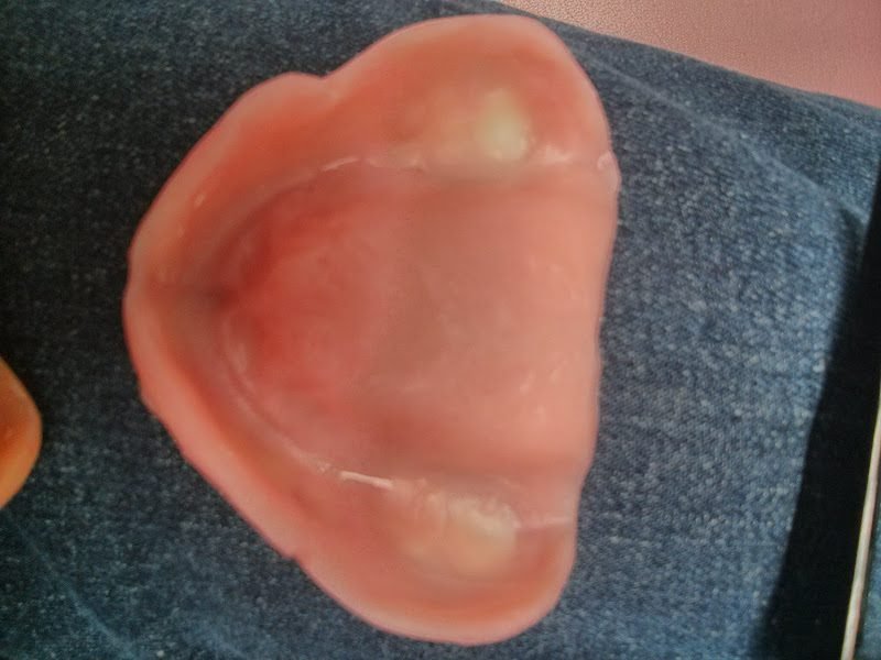 1 Day Denture