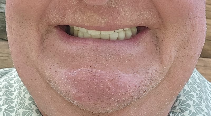 Next Step Smiles Dental Implant Center