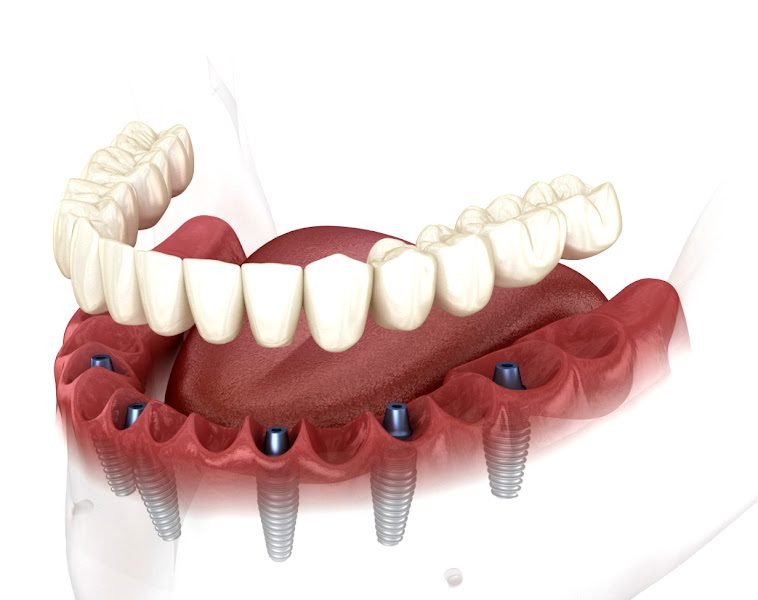 Advanced Dental Implant and TMJ Center 4