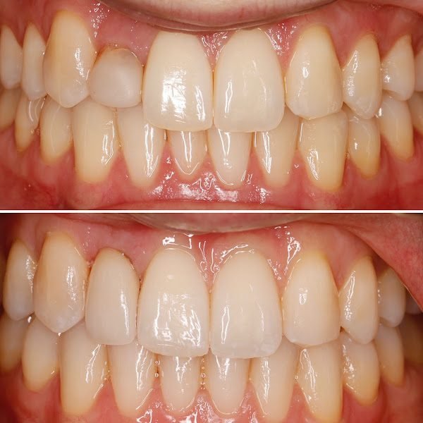 Dental Implants Brookline 6