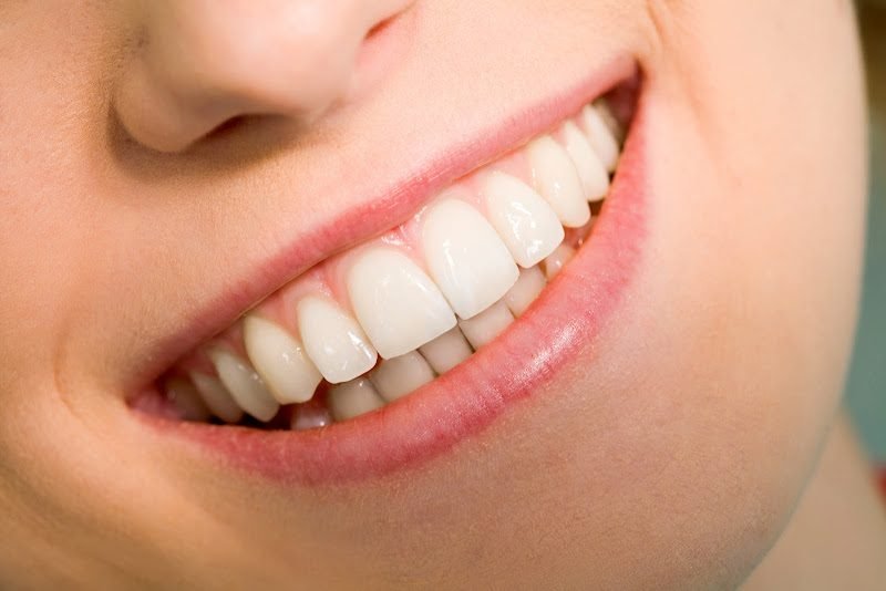 Expert Veneers of Denver