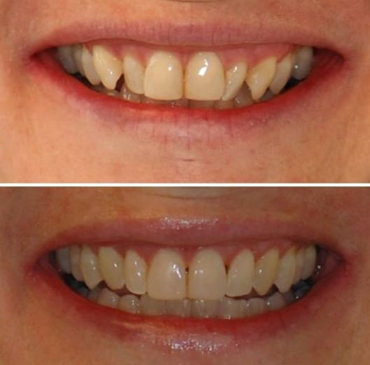 Las Vegas Invisalign