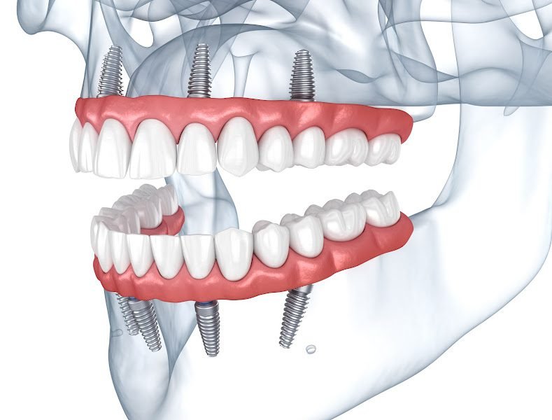 Now Dentures and Implants 2