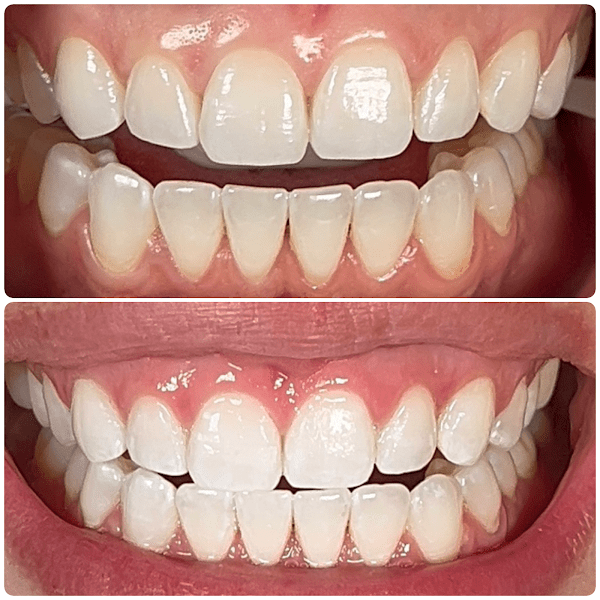 Organic Radiance Teeth Whitening